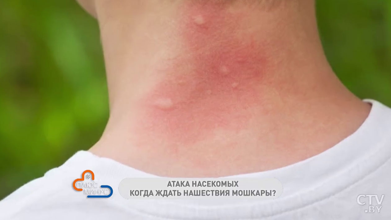 Особенно опасно для аллергиков. Первая помощь при укусе мошки-4