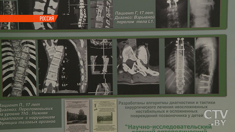 Помочь детям с врождёнными изменениями позвоночника. Врачи Беларуси и России совместно проводят уникальные операции-4 Помочь детям с врождёнными изменениями позвоночника. Врачи Беларуси и России совместно проводят уникальные операции-4