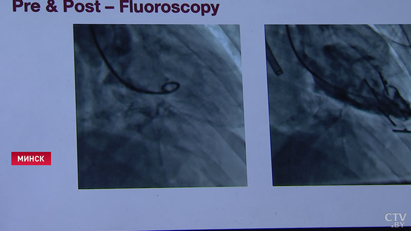 Качество жизни пациента значительно улучшится. Гибридную операцию на сердце впервые провели в Беларуси -4