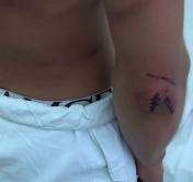 Синяки, ссадины и гематомы, в том числе и на женщине. Кадры для тех, кто считает историю с иракцами на границе выдуманной