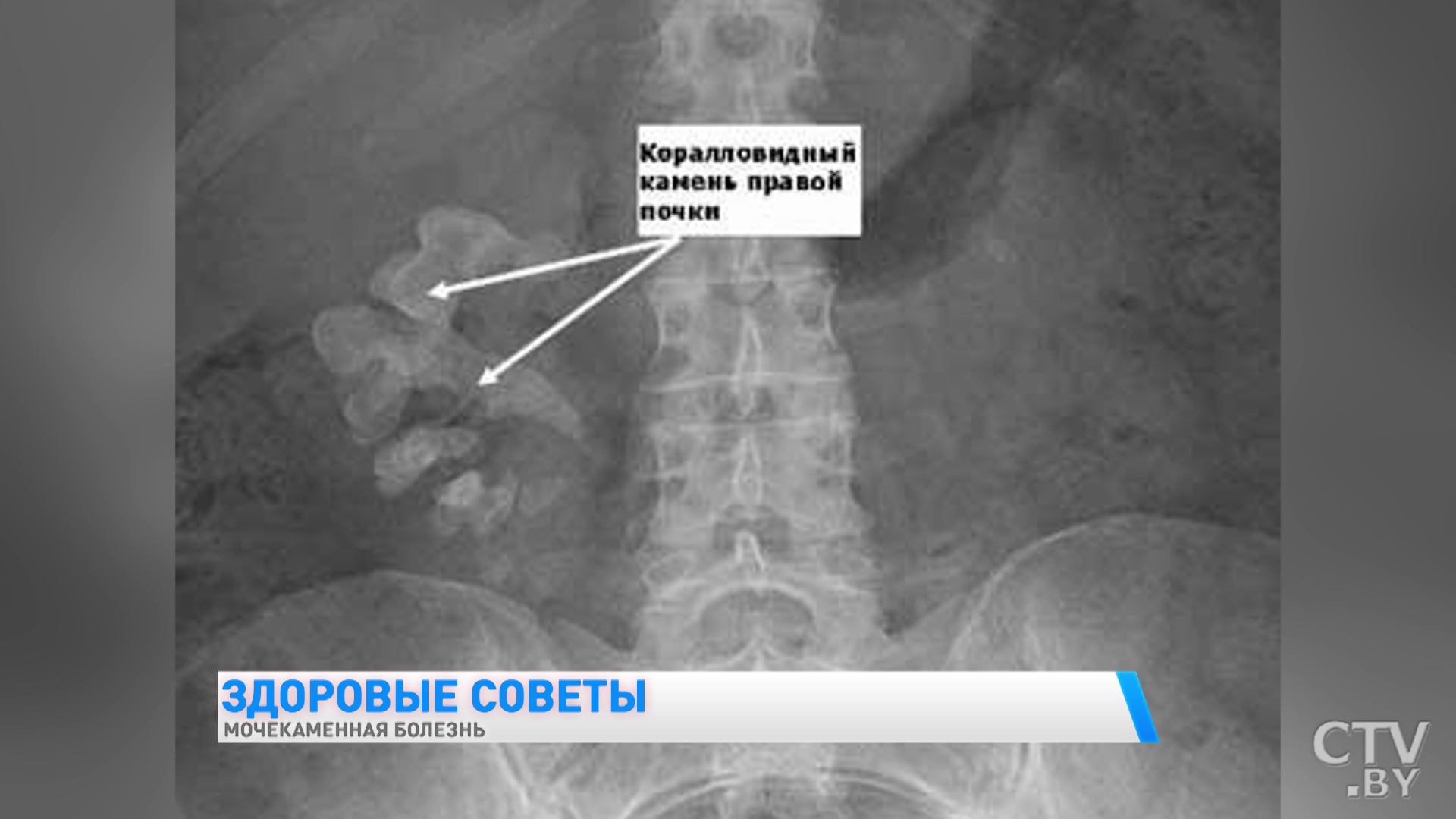 Мочекаменная болезнь. Врач рассказывает о первых симптомах-13