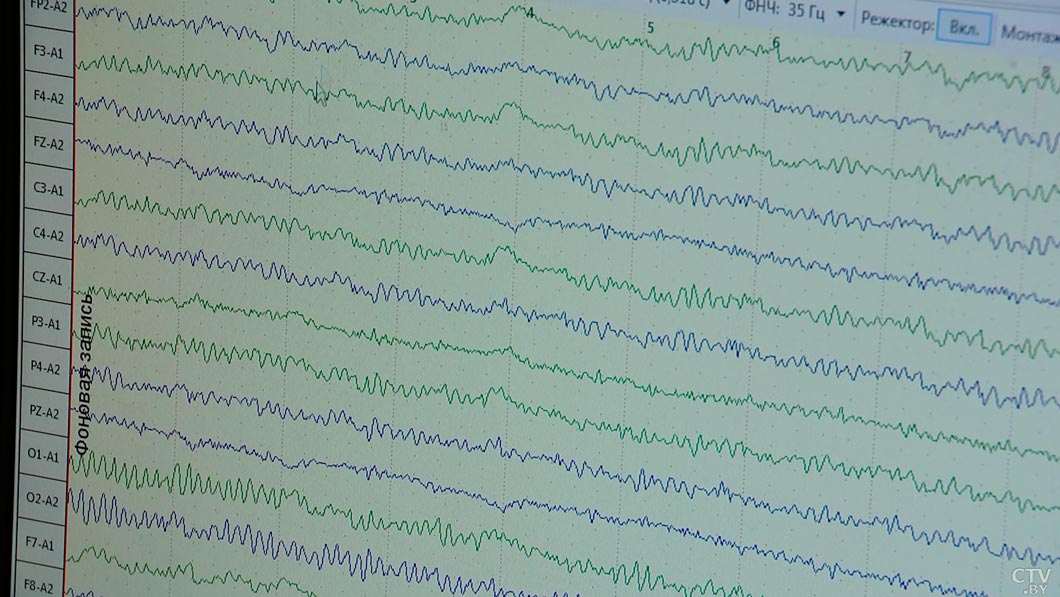 Более 50 млн человек в мире страдают эпилепсией. Врач рассказала, как можно контролировать заболевание-8