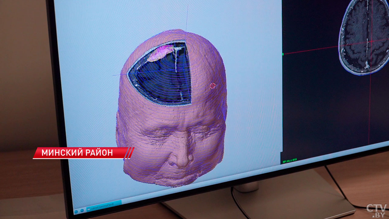 Без скальпеля и крови – в РНПЦ онкологии и медицинской радиологии представили новую версию гамма-ножа-10