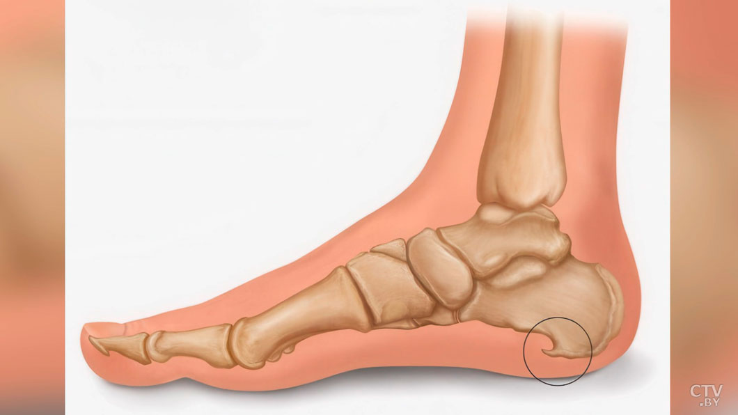Пяточная шпора: как избавиться от острой боли при ходьбе-1