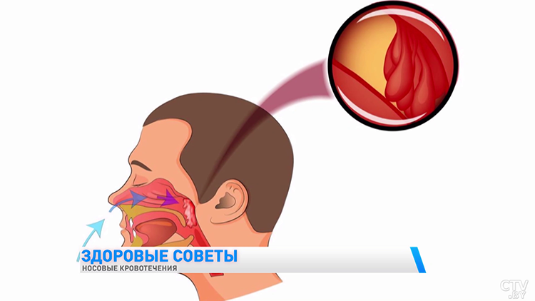 Носовые кровотечения. Что это, просто лопнувший сосуд или симптом серьёзной болезни?-7
