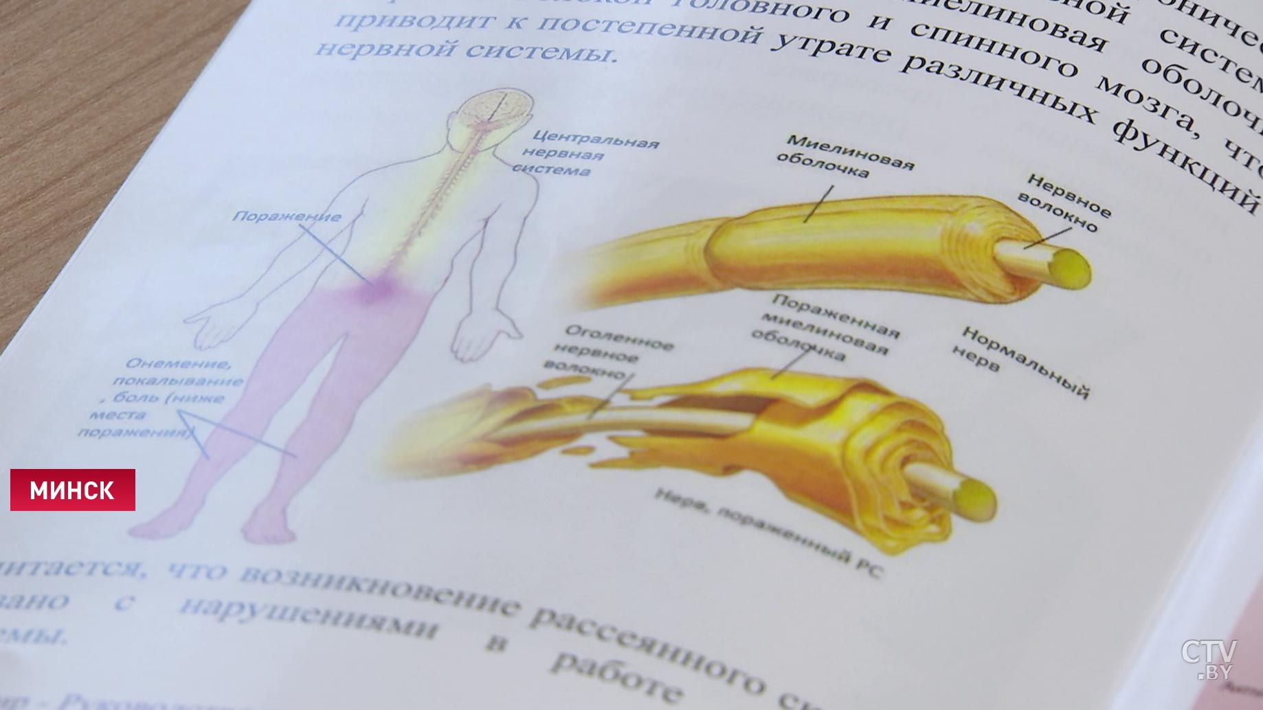 Белорусские учёные разработали лекарство, которое помогает больным с рассеянным склерозом -14