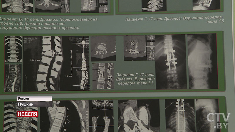 «Он может стать кем угодно». Врачи Беларуси и России разработали уникальную методику операции на позвоночнике у детей-9