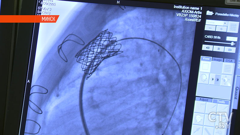 В Беларуси впервые провели уникальную операцию по замене клапана лёгочной артерии-3