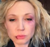 Кристина Орбакайте опубликовала фото со следами побоев на лице Кристина Орбакайте опубликовала фото со следами побоев на лице
