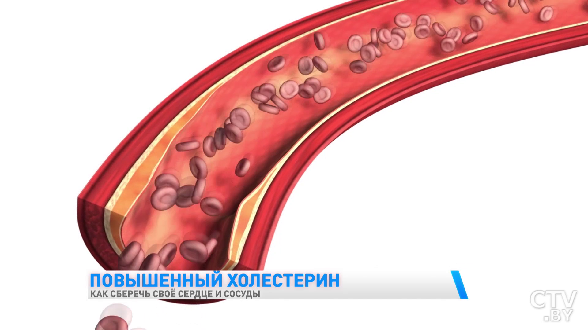 У вас повышенный уровень холестерина? Эти рекомендации врача-кардиолога стоит соблюдать -6