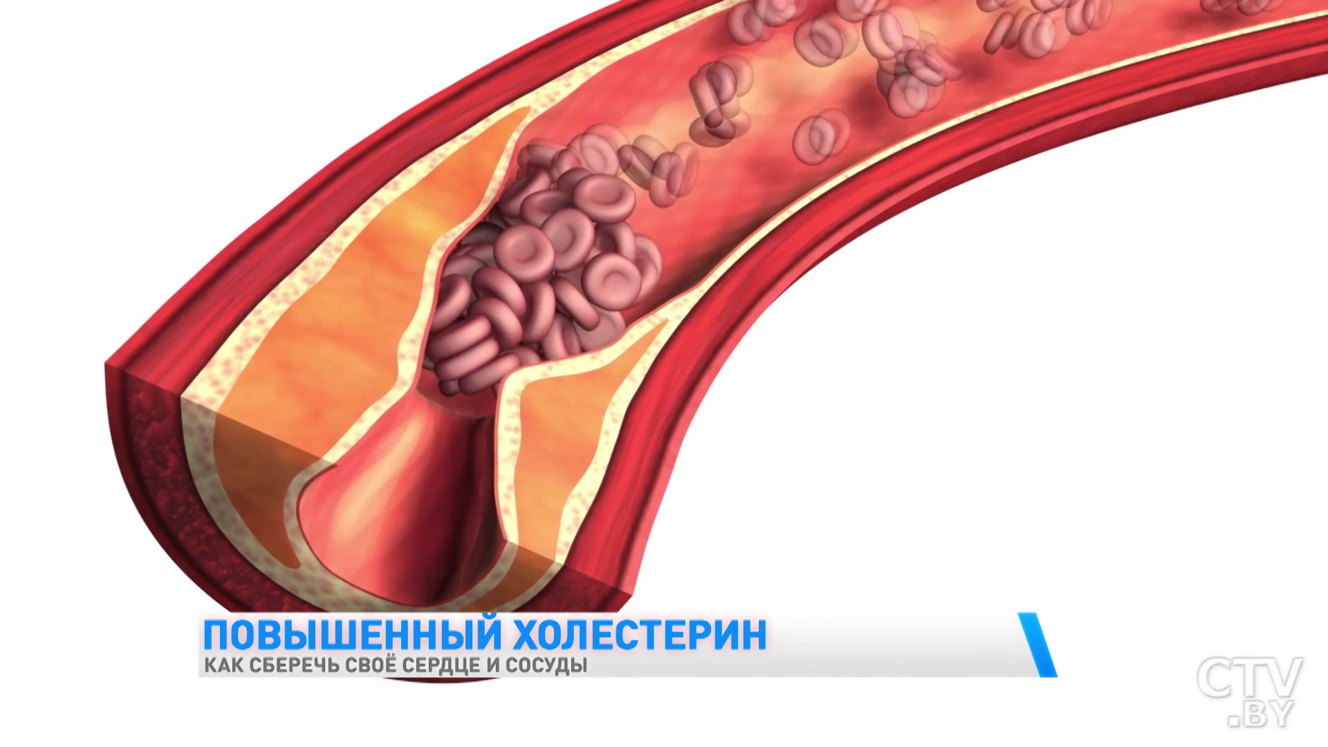 У вас повышенный уровень холестерина? Эти рекомендации врача-кардиолога стоит соблюдать -4