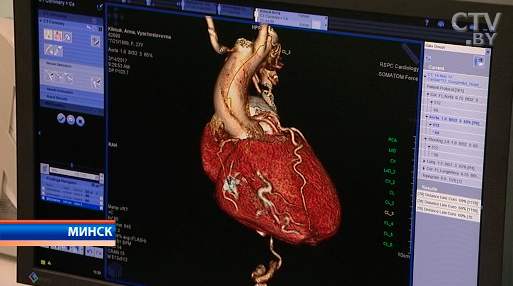 Первые операции с использованием 3D-модели сердца провели в Беларуси -4