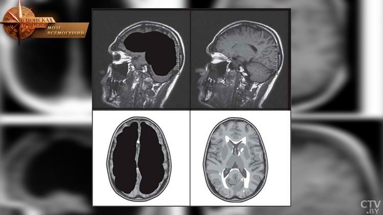 Француз дожил до 50 лет с мозгом размером с горошину! Как такое возможно?-4