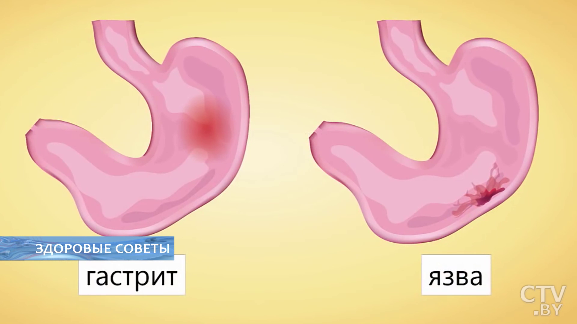 С этой проблемой сталкиваются те, кто неправильно питается. Как пройти обследование желудка без неприятных ощущений?-1