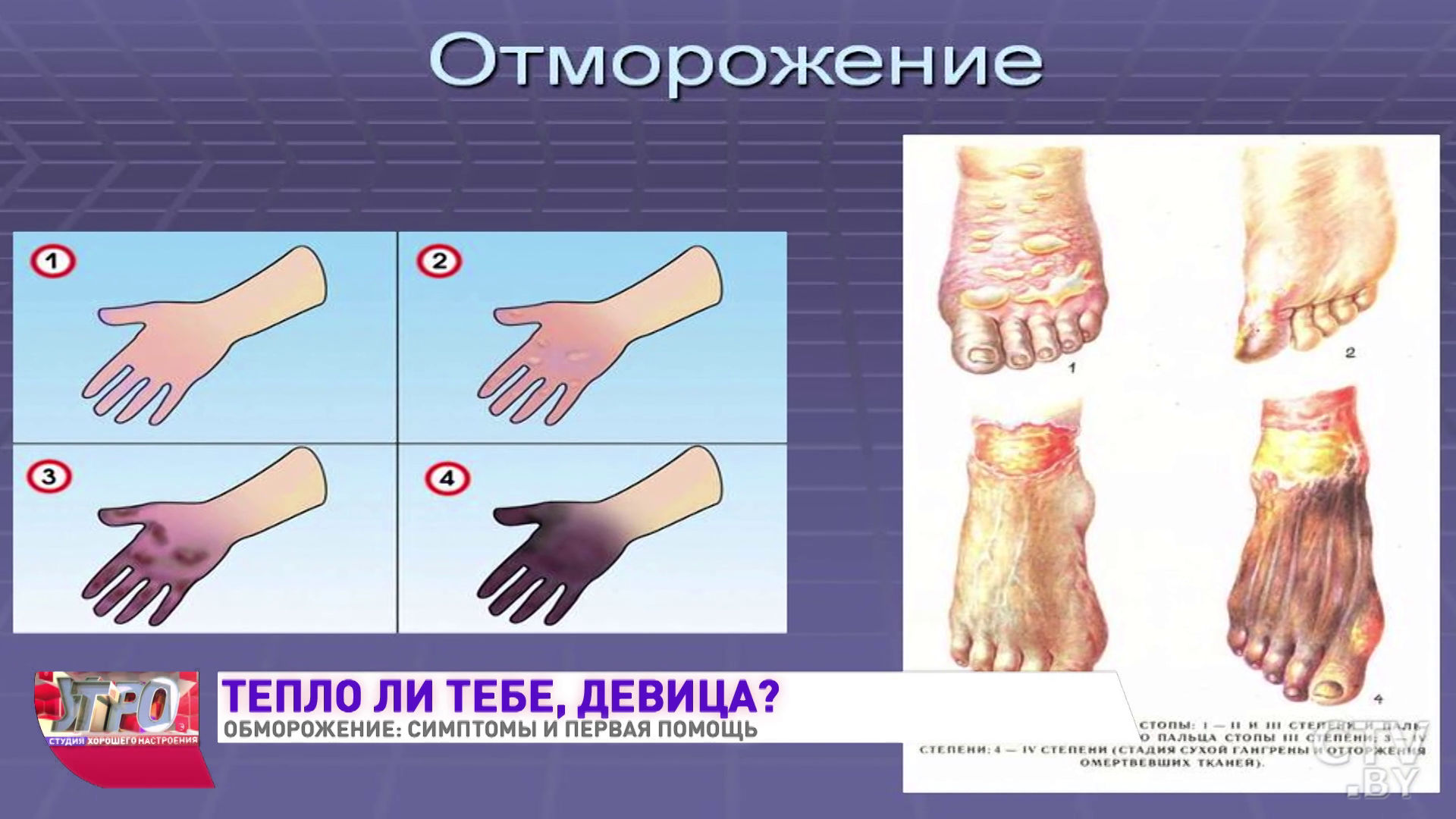 Что делать при обморожении и как его избежать. Советы полярника и врача-22