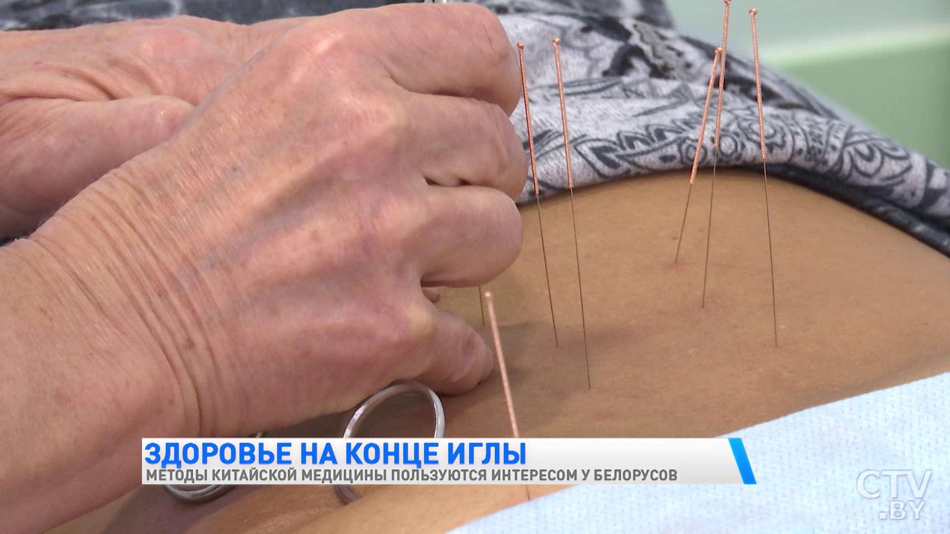 «При введении иглы чувствуется тепло или отдача тока». Как делают иглоукалывание и кому оно необходимо-7